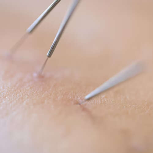 Acupuntura 03