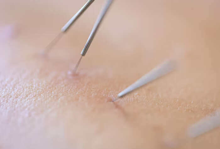 Acupuntura 03