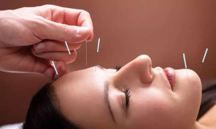 Acupuntura 08